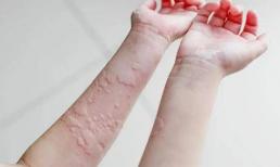 Ngứa “4 nơi” trên cơ thể, đừng nghĩ là dị ứng, hay liên quan đến tế bào ung thư, nên đi khám sớm
