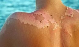 Phục hồi da cháy nắng sạm đen ngày hè nhờ những bí quyết dễ như 'ăn kẹo' này 