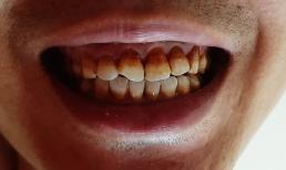 Đàn ông tuổi thọ ngắn đa phần đều có đặc điểm 'hai bẩn hai hôi'