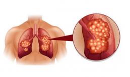 Ung thư phổi thầm lặng? Có 4 bất thường trong cơ thể, đó là ung thư phổi gõ cửa! 