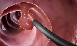 Trong ruột có polyp, đi vệ sinh sẽ có nhắc nhở! Đừng đợi đến giai đoạn giữa và cuối chuyển ung thư mới tìm hiểu