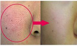 Chỉ cần một hành động để giải quyết vấn đề về lỗ chân lông to! Làn da ngay lập tức trở nên siêu mịn màng siêu mỏng manh