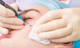 Tẩy nốt ruồi có an toàn không? Những nốt ruồi nào là không thể tẩy? Rất ít người biết câu trả lời chính xác