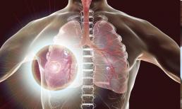 Ung thư phổi, giấc ngủ tiên tri? Nếu bạn có 5 dấu hiệu này khi ngủ, đó có thể là cảnh báo sớm của bệnh ung thư phổi 