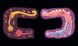 “Ung thư đại trực tràng” im lặng? Nếu có 4 'điềm báo' này trong phân, ung thư ruột đã 'dậy sóng' rồi