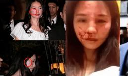 Ảnh Lâm Chí Linh trong bệnh viện, mặt bầm tím và mũi bị vẹo vì bị người chồng bạo hành sau khi vợ phát hiện anh qua lại với 3 cô gái?