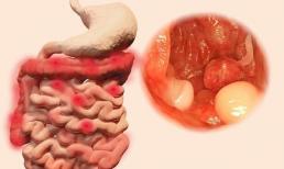 Có polyp trong ruột, khi đi vệ sinh sẽ có 2 tín hiệu, đừng đợi đến giai đoạn muộn mới phản ứng