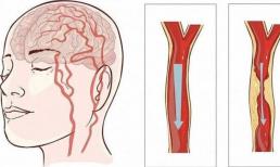 Một phụ nữ 50 tuổi, bị liệt do nhồi máu não sau bữa ăn, cảnh báo: Người trung niên và người già nên cố gắng làm 5 việc sau bữa tối càng ít càng tốt