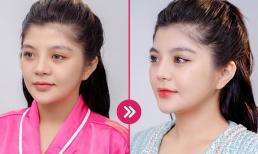 Nâng mũi bằng sụn tai là gì? Địa chỉ nâng mũi uy tín