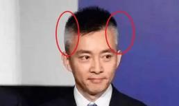 Tóc bạc trắng trên đầu có bệnh gì không và khi mọc ở thái dương, trán, đỉnh đầu là bệnh gì? 