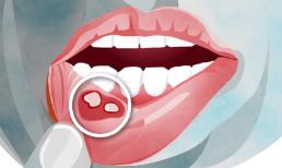 Vì sao hiện nay bệnh ung thư miệng ngày càng nhiều và chủ yếu là phụ nữ? Bác sĩ nói sự thật!