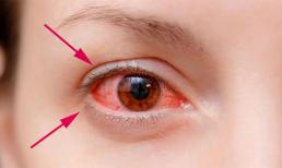 Dịch đau mắt đỏ đang hoành hành, liệu nhìn vào mắt người bệnh có bị lây không?