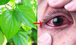Chữa đau mắt đỏ bằng lá trầu không có thực sự hiệu quả? Những sai lầm khiến bệnh đau mắt đỏ càng thêm nặng