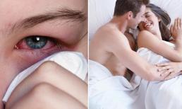 Đang đau mắt đỏ có cần kiêng chuyện 'giường chiếu' không?
