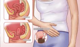 Bệnh sa tử cung là gì? Lý do chính là gì? Phụ nữ nên tránh xa căn bệnh “ung thư xã hội” này