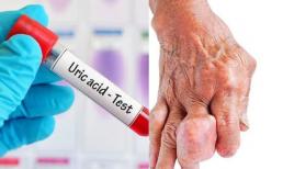 Ba món thường gặp trên bàn ăn này có thể làm tăng axit uric hơn cả việc uống rượu! 6 dấu hiệu cảnh báo axit uric tăng đột biến