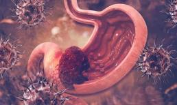 Bằng cách làm 3 điều này, bạn có thể ngăn ngừa ung thư dạ dày! Đầu tiên, nhiều người không thể giúp được