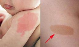 Đứa trẻ nào khi sinh ra hầu như đều có bớt trên người, nhưng nếu xuất hiện ở 10 vị trí sau báo hiệu số kiếp giàu sang