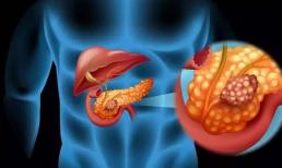 Ung thư tuyến tụy: chỉ 3 tháng từ khi phát hiện đến khi tử vong! Bốn triệu chứng có thể là tuyến tụy của bạn đang cầu cứu