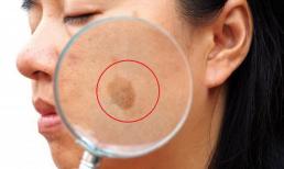 Tại sao khuôn mặt một số người lại đầy 'đốm đồi mồi' trong khi những người khác lại sạch sẽ? Cuối cùng bác sĩ đã nói ra sự thật