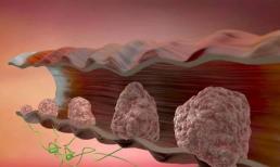 Lời khuyên của bác sĩ: Nếu không muốn polyp ruột biến thành ung thư ruột, hãy cố gắng ăn càng ít “4 thứ” càng tốt: Dù tham lam đến mấy cũng phải nhịn