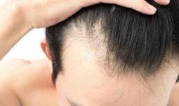  Mái tóc mỏng? Hóa ra đây là yếu tố cơ thể bị “thiếu”! Hãy bổ sung thêm để tóc của bạn mọc nhiều