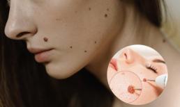 Tẩy nốt ruồi có giúp chúng ta đổi vận không? Khoa học nói gì?