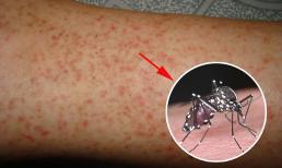 Thời tiết nóng ẩm, đây là cách tránh muỗi đốt, phòng bệnh sốt xuất huyết cho người lớn trẻ nhỏ