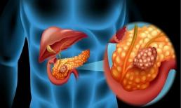 Bị viêm gan B có thể phát triển thành ung thư không? Khi cơ thể phát ra 4 'báo động' này, đó có thể là dấu hiệu của bệnh ung thư tuyến tụy!