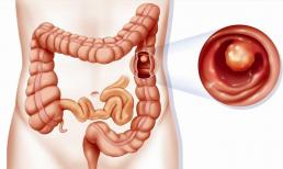 Nguyên nhân gây ra polyp đại tràng là gì? Khi polyp xuất hiện, có thể sử dụng ba phương pháp để điều trị 