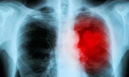 Nếu 4 hiện tượng này xuất hiện trong cơ thể, bạn hãy cảnh giác với khả năng mắc bệnh ung thư phổi