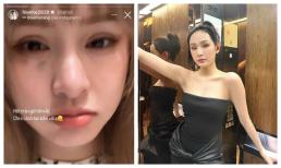 Hiền Hồ đăng ảnh thương tích đầy mặt, dân tình lại nghi chiêu trò