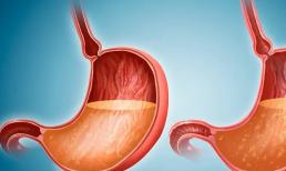 Trước khi ung thư dạ dày tấn công, cơ thể có thể gửi đi hai tín hiệu mà hầu hết mọi người có xu hướng bỏ qua