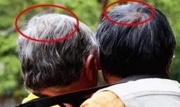 Tóc bạc mọc ở đâu thì bệnh tật sẽ xuất hiện? Trên trán, thái dương và sau đầu, chúng ám chỉ điều gì?