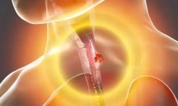 Tưởng viêm họng mãn tính, đi khám và được phát hiện mắc ung thư thực quản? Bác sĩ: 5 điểm khác biệt cần hiểu