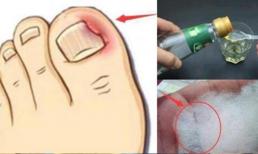 Móng tay của bạn luôn mọc vào trong và bị đau khi chạm vào? Dạy bạn một mẹo tự giải quyết, không cần phiền bác sĩ nữa 