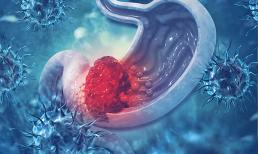 90% ung thư dạ dày không được phát hiện cho đến giai đoạn muộn! 4 triệu chứng sau bữa ăn là dấu hiệu nguy cơ cao! 