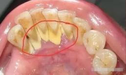 Không cần đến bác sĩ, bạn có thể tự thực hiện tại nhà với '5 mẹo' dễ dàng để loại bỏ cao răng 