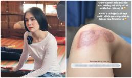 Ngọc Trinh cập nhật vết sẹo sau tai nạn xe mô tô, dân mạng thở phào về tình hình hiện tại 