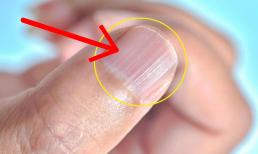 Có những đường thẳng đứng trên móng tay của tôi, chuyện gì xảy ra vậy? Có phải gan có vấn đề? Đọc xong tôi có thêm kiến thức