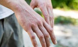 Những bệnh ngoài da nào dễ lây? 5 bệnh này có khả năng lây lan cao cần phải đề phòng 