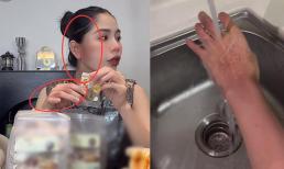 Hằng Du Mục đăng ảnh tay tím bầm giữa nghi vấn bị chồng bạo hành, Quang Linh Vlogs có chia sẻ kèm icon tức giận