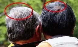 Tóc bạc mọc ở đâu thì bệnh sẽ xuất hiện? Mọc ở trán, thái dương, sau đầu có ý nghĩa gì?