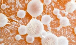 Khi phát hiện ra ung thư tuyến tụy, có phải bệnh đã ở giai đoạn muộn? Tốt nhất bạn nên ghi lại 5 dấu hiệu này