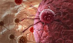 Bệnh nhân ung thư thường có 7 đặc điểm chung, nếu bạn có một trong số đó hãy thay đổi sớm để tránh tế bào ung thư 'tìm đến nhà'