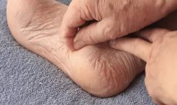 Trong cơ thể có ung thư, nhìn chân có biết không? Bác sĩ nhắc nhở: 3 “dấu hiệu” xuất hiện ở bàn chân, hay là điềm báo ung thư gan