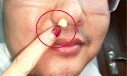 Đưa tỏi vào lỗ mũi có thể nhiều người chưa biết nó có công dụng diệu kỳ như vậy