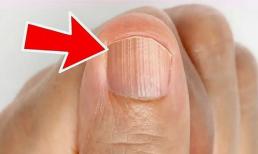 Dù bạn là nam hay nữ, nếu móng tay của bạn có “đường thẳng đứng” thì ba “căn bệnh” sẽ ập đến trước cửa nhà bạn