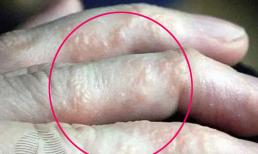 Nếu bạn có thứ này trên ngón tay, điều đó có nghĩa là cơ thể bạn cần được giải độc.
