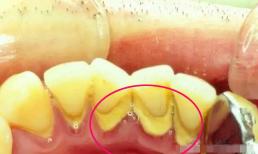 Nếu bạn có 'sỏi' mọc trên răng thì đây là cách đơn giản để loại bỏ chúng mà không cần phải đến nha sĩ